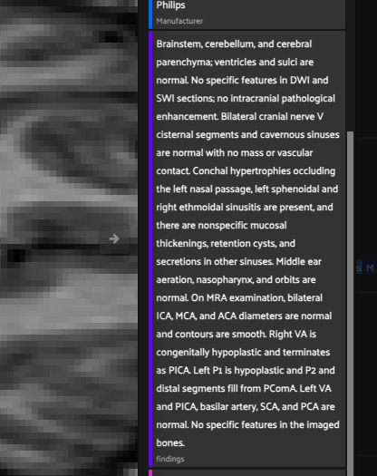 FiftyOne app showing a brain MRI scan beside its full radiology report findings and impression