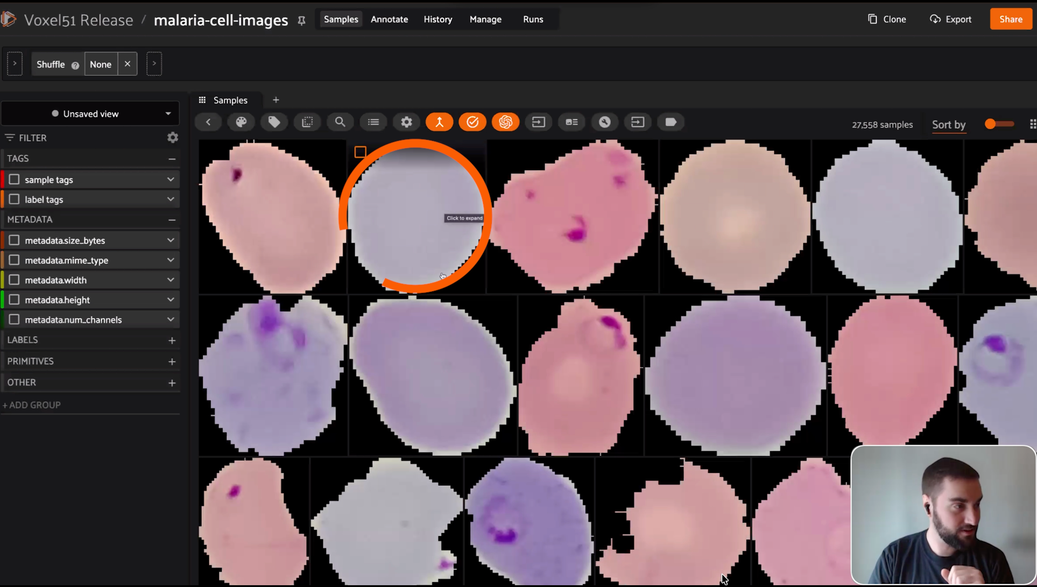 FiftyOne sample grid of 27,558 malaria cell images, some with dark parasite splotches and some uninfected