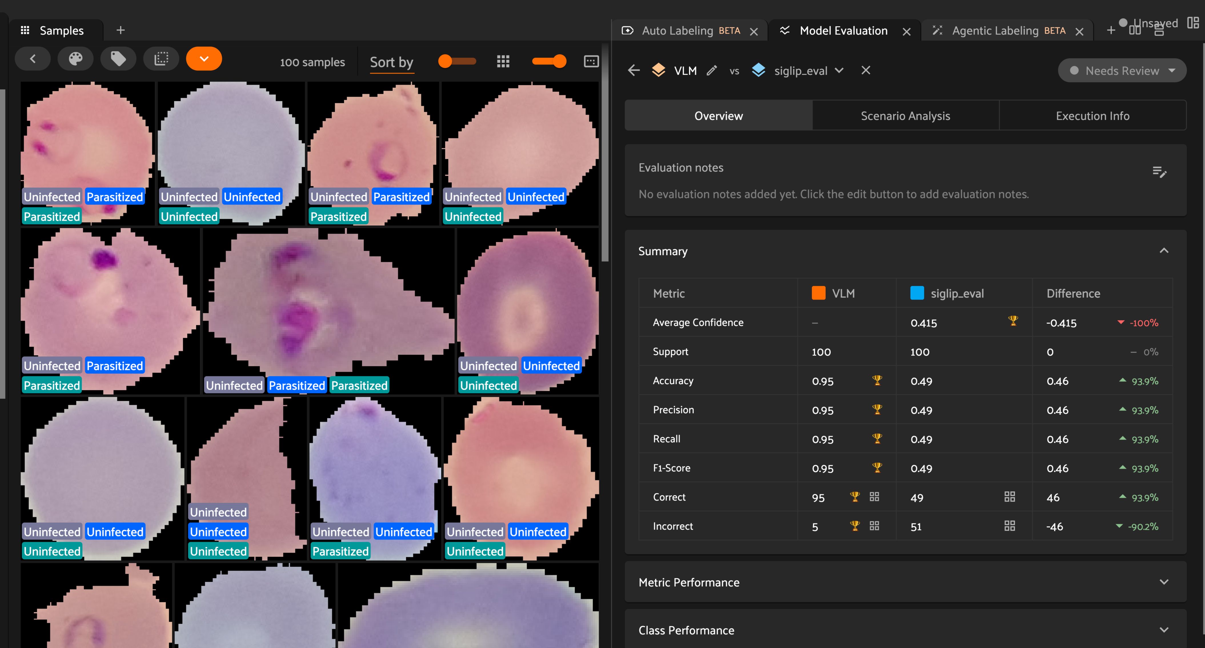 FiftyOne's VLM-based Agentic Labeling outperforms SigLIP on malaria cell classification with 95% vs. 49% accuracy (+93.9%) across 100 samples in FiftyOne's Model Evaluation panel