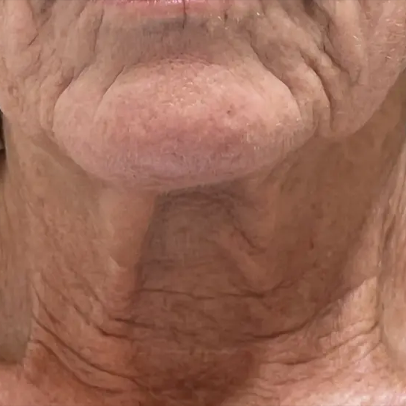 Client before Procell Microchanneling at EBSKIN