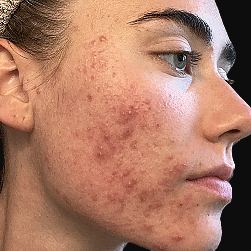 Client before Face Reality acne treatment at EBSKIN