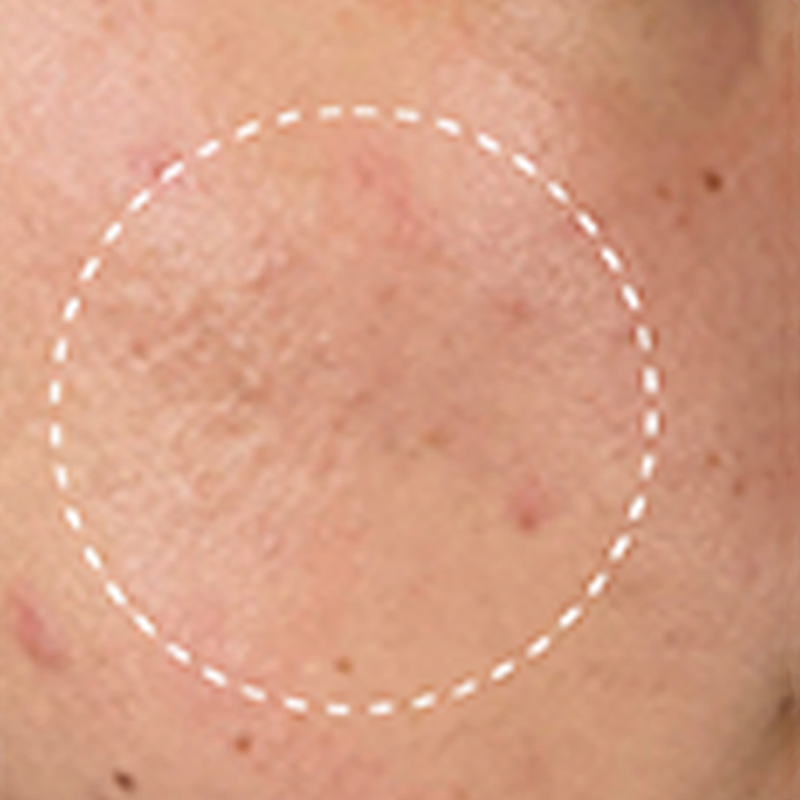 Client after Deluxe Hydrafacial at EBSKIN