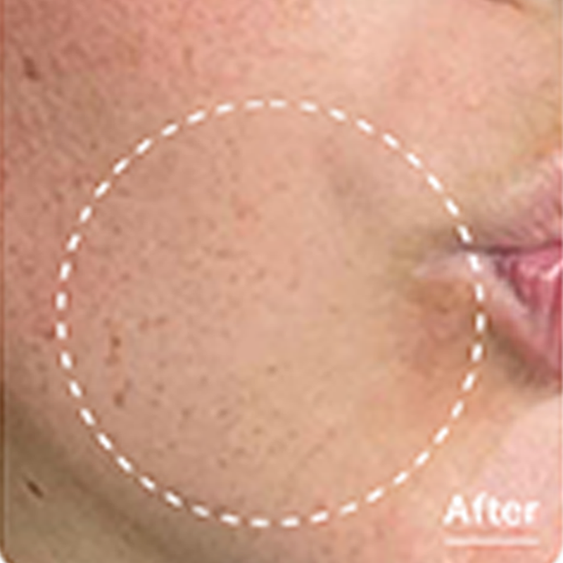 Client after Platinum Hydrafacial at EBSKIN