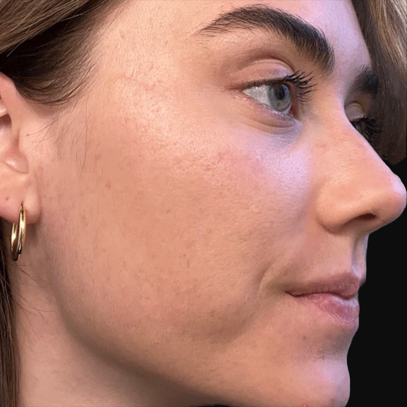 Client after Face Reality acne treatment at EBSKIN