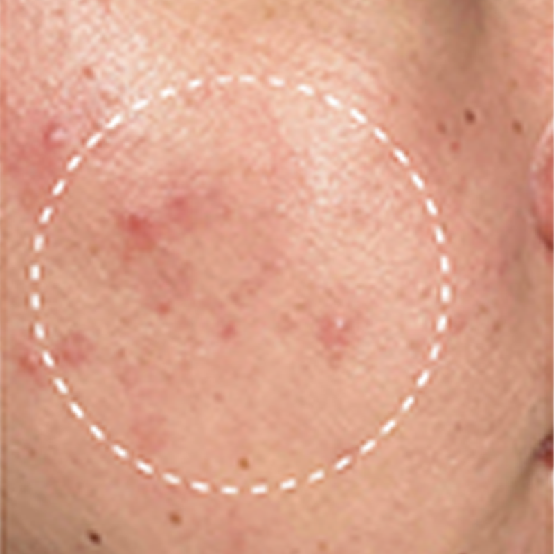Client before Deluxe Hydrafacial at EBSKIN