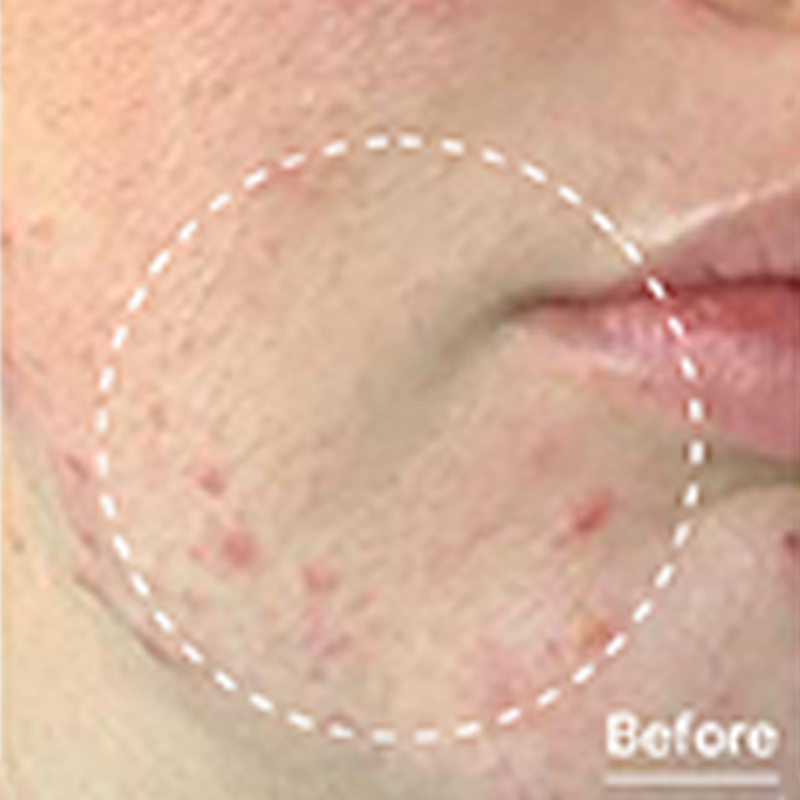 Client before Platinum Hydrafacial at EBSKIN