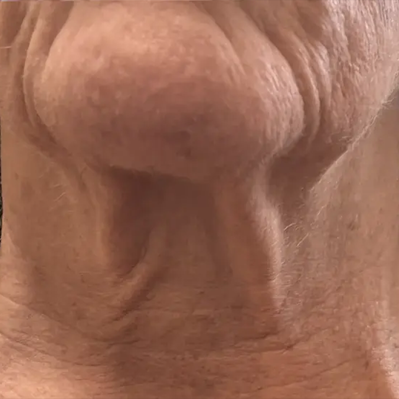 Client after Procell Microchanneling at EBSKIN