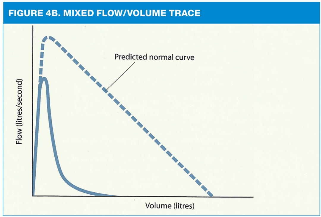 Spirometry: Understanding the results