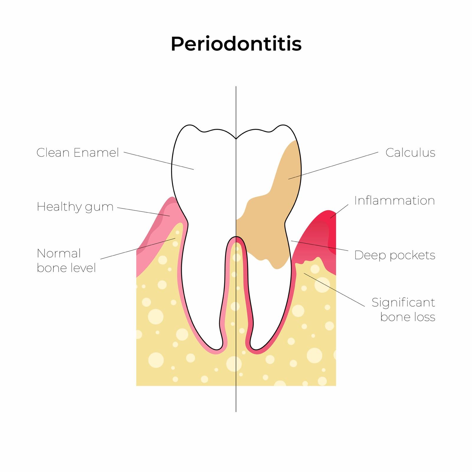 Illustrasjon av periodontitt der tannstein, betent tannkjøtt, dype lommer og tap av benfeste er merket av