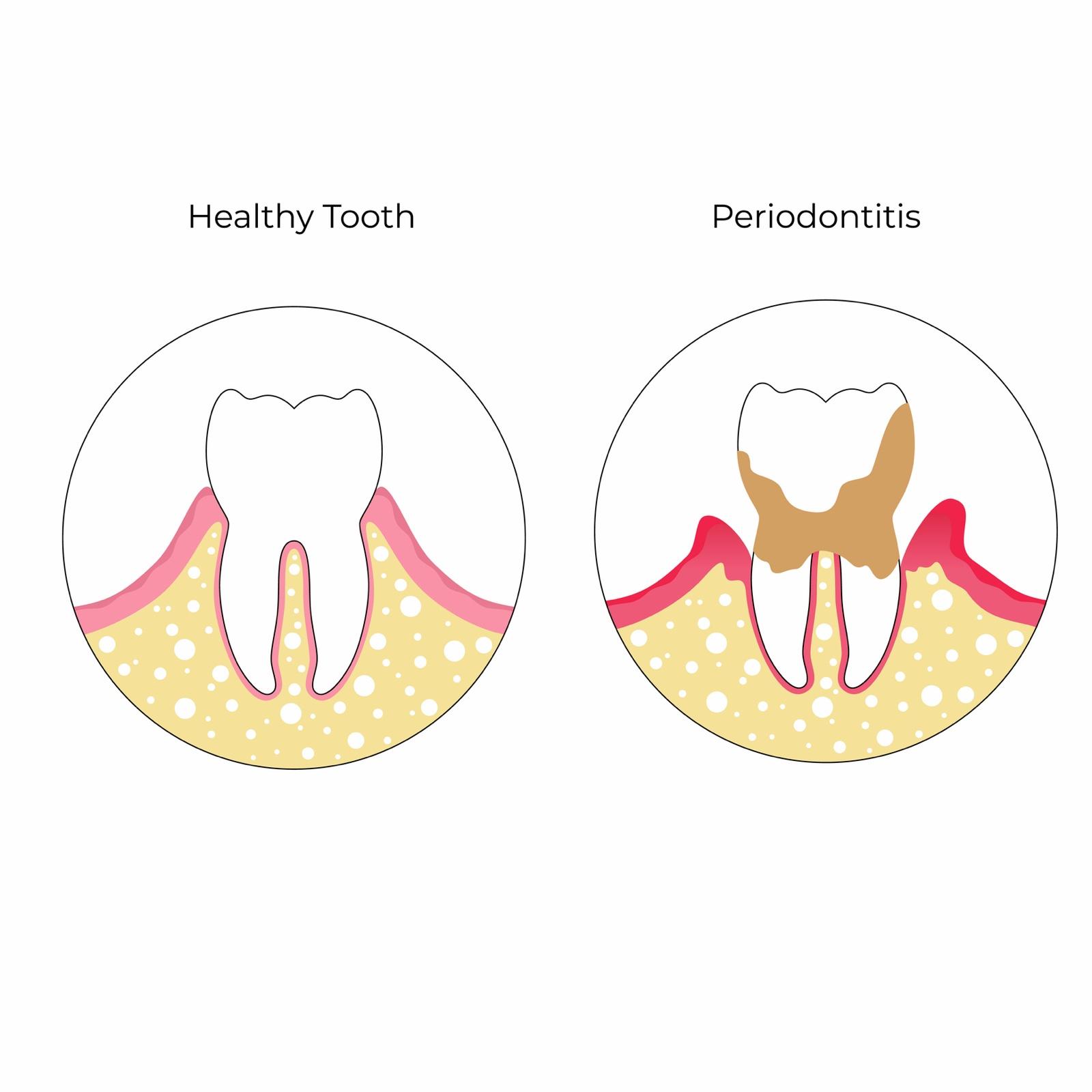 Illustrasjon som sammenligner en frisk tann med en tann som har mistet benfeste ved periodontitt