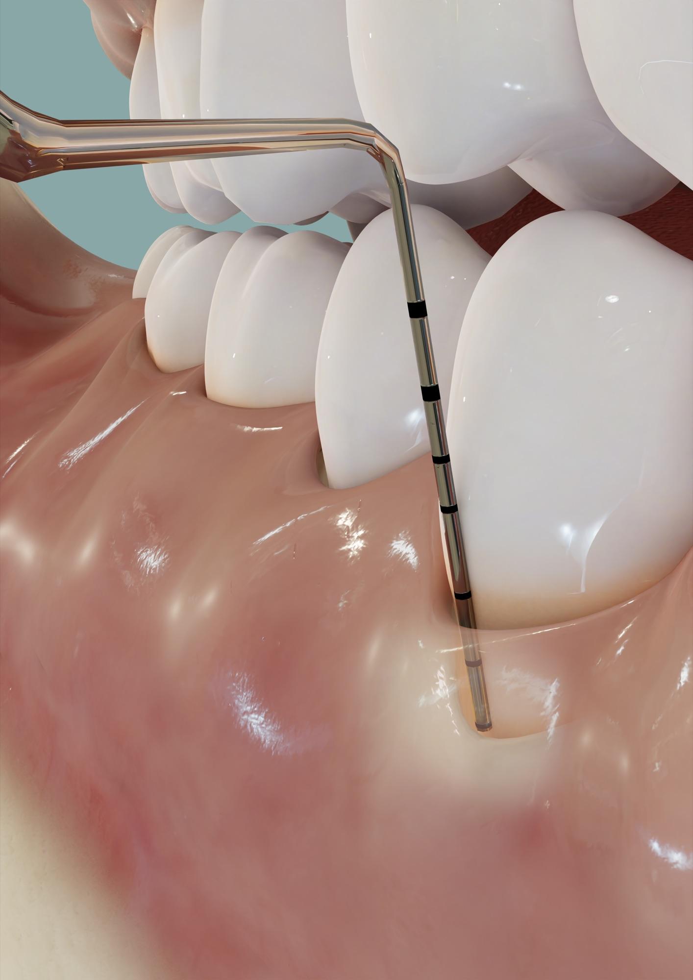 Periodontal sonde med millimetermarkering ført ned i tannkjøttlommen mellom to tenner