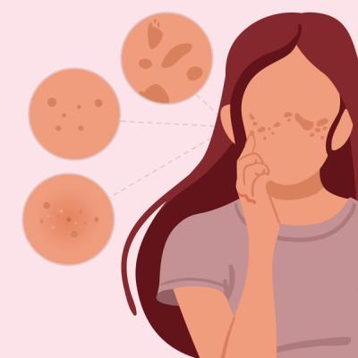 Illustration of a woman trying to identify melasma vs hyperpigmentation vs sun spots.
