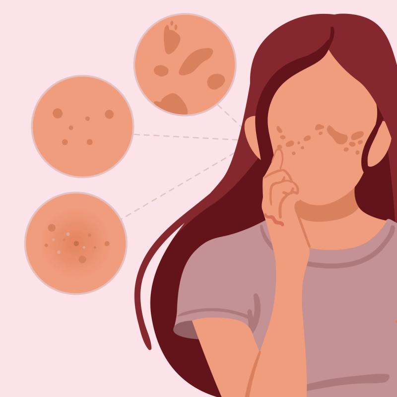 Illustration of a woman trying to identify melasma vs hyperpigmentation vs sun spots.