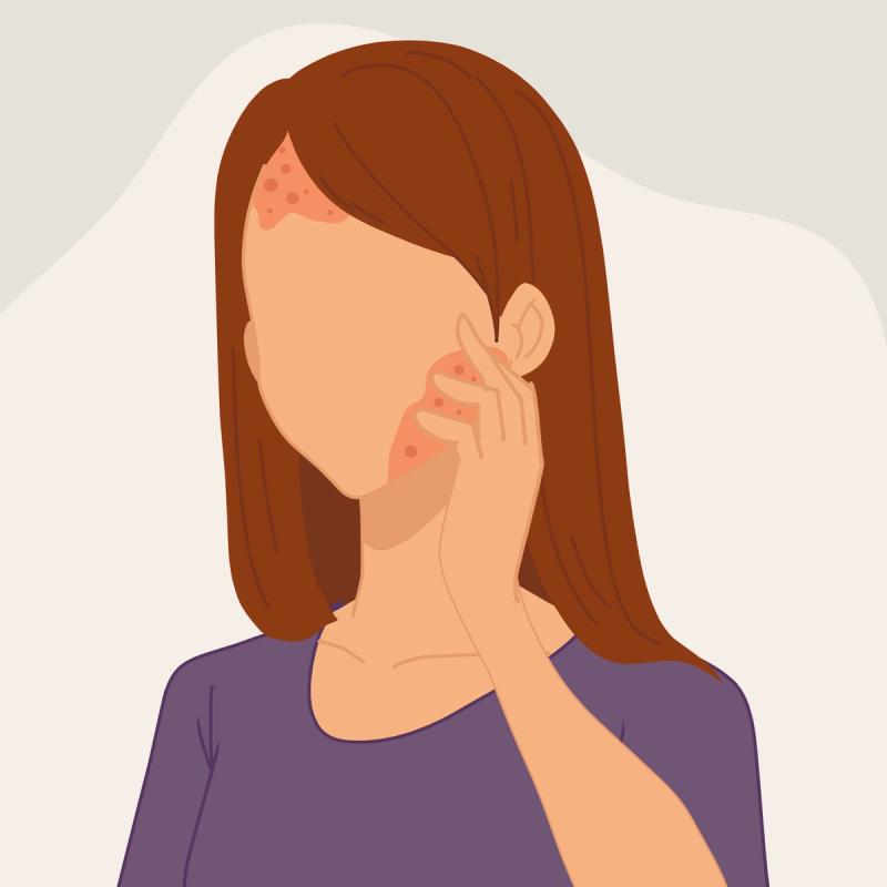 An illustration of a person affected by shingles.