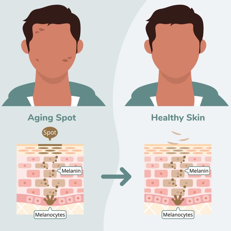 Illustration of How Hydroquinone Cream Works