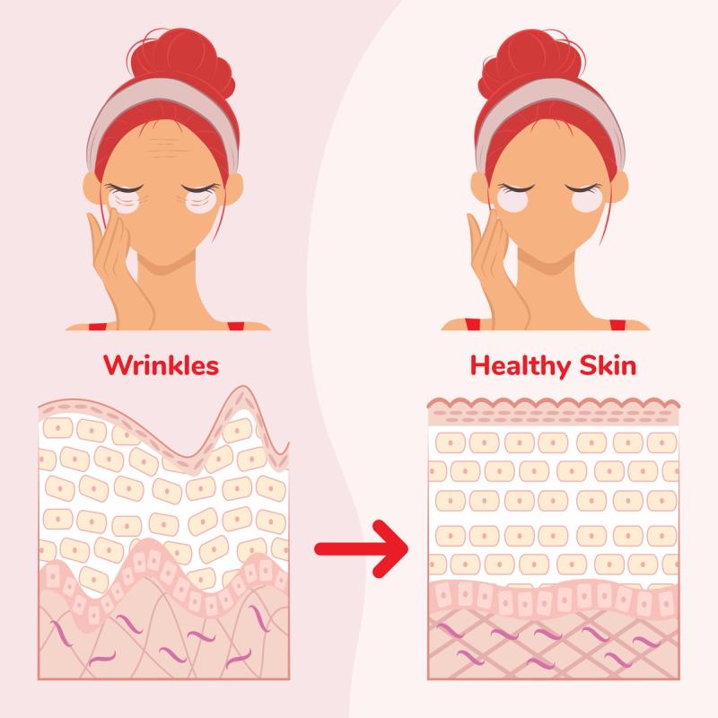 Illustration of How Tretinoin (Retin-A®) Cream Works