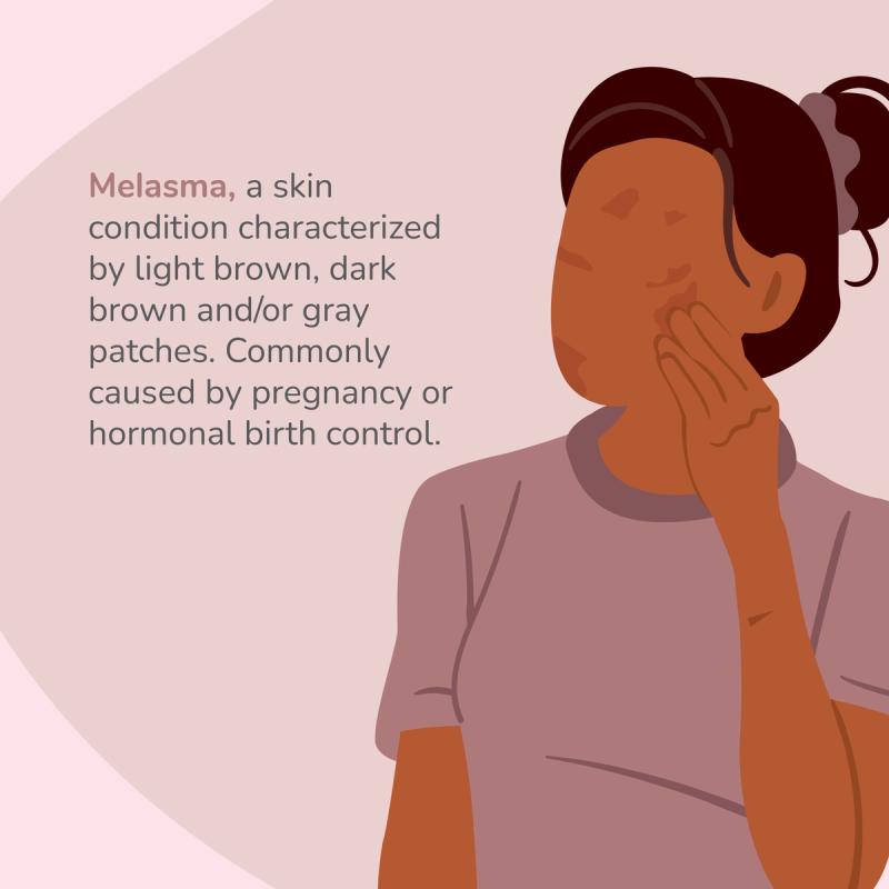 Illustration of someone with melasma.