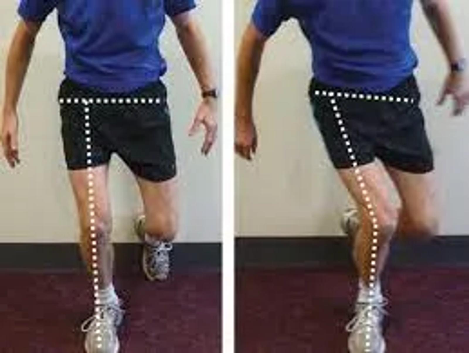 Comparison of neutral knee alignment versus the knee collapsing inwards