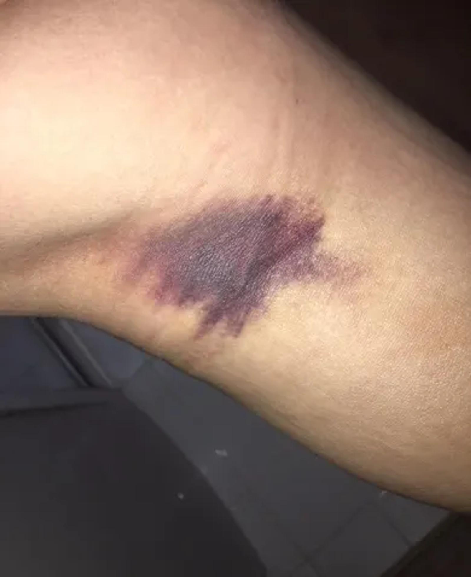 The extent of the knee swelling after the injury