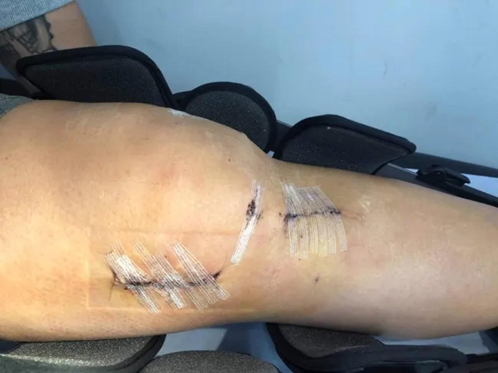 Recovery following the second operation