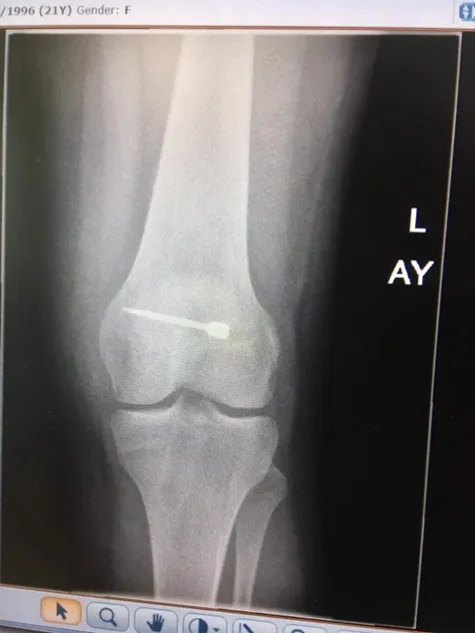 Recovery following the first operation