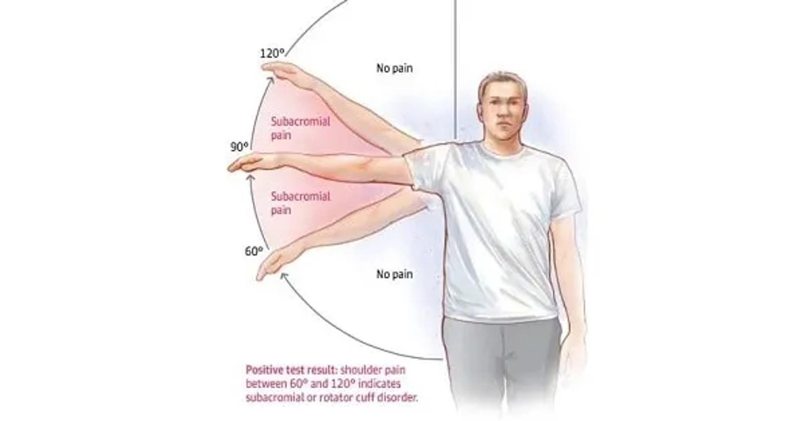 Painful arc syndrome of the shoulder