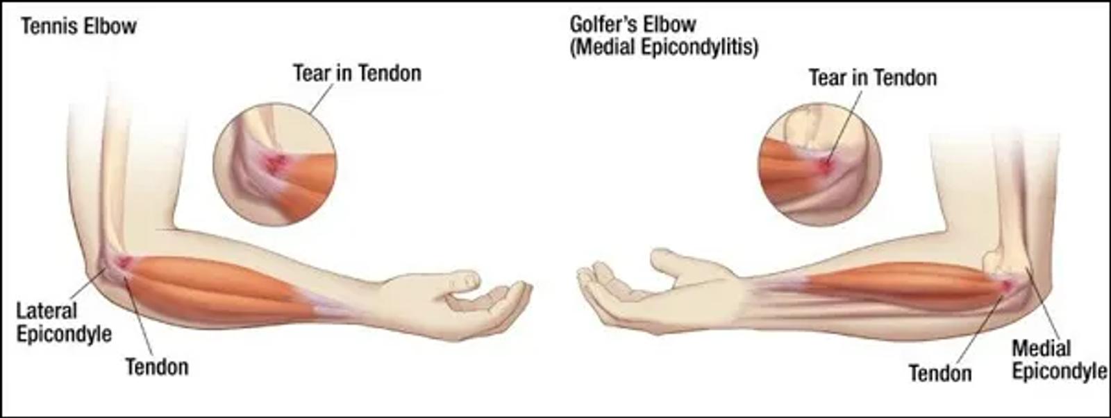 Diagram of tennis elbow and golfer's elbow