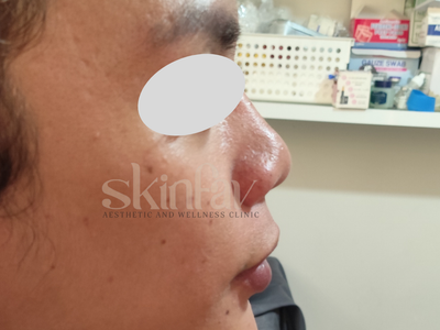 Nonsurgical Nose Lift