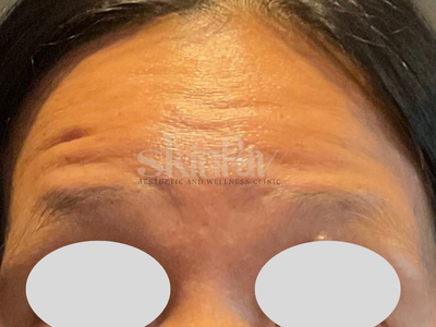 Forehead Wrinkles & Lines