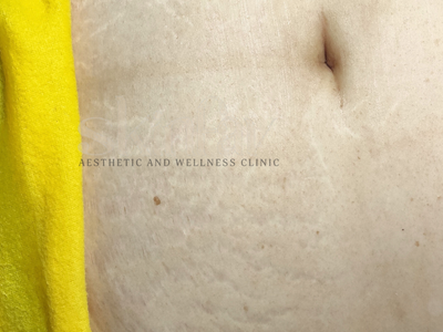 Stretch Marks Removal
