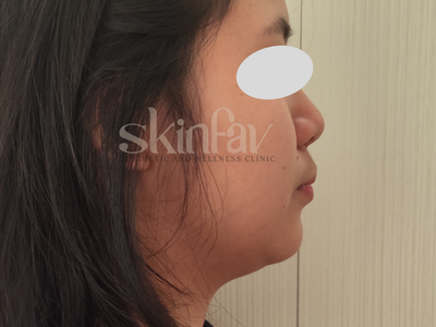 Mesolipo (Fat Dissolving Injections)