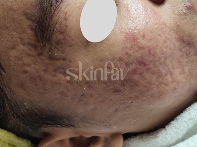 Acne Scar Treatment