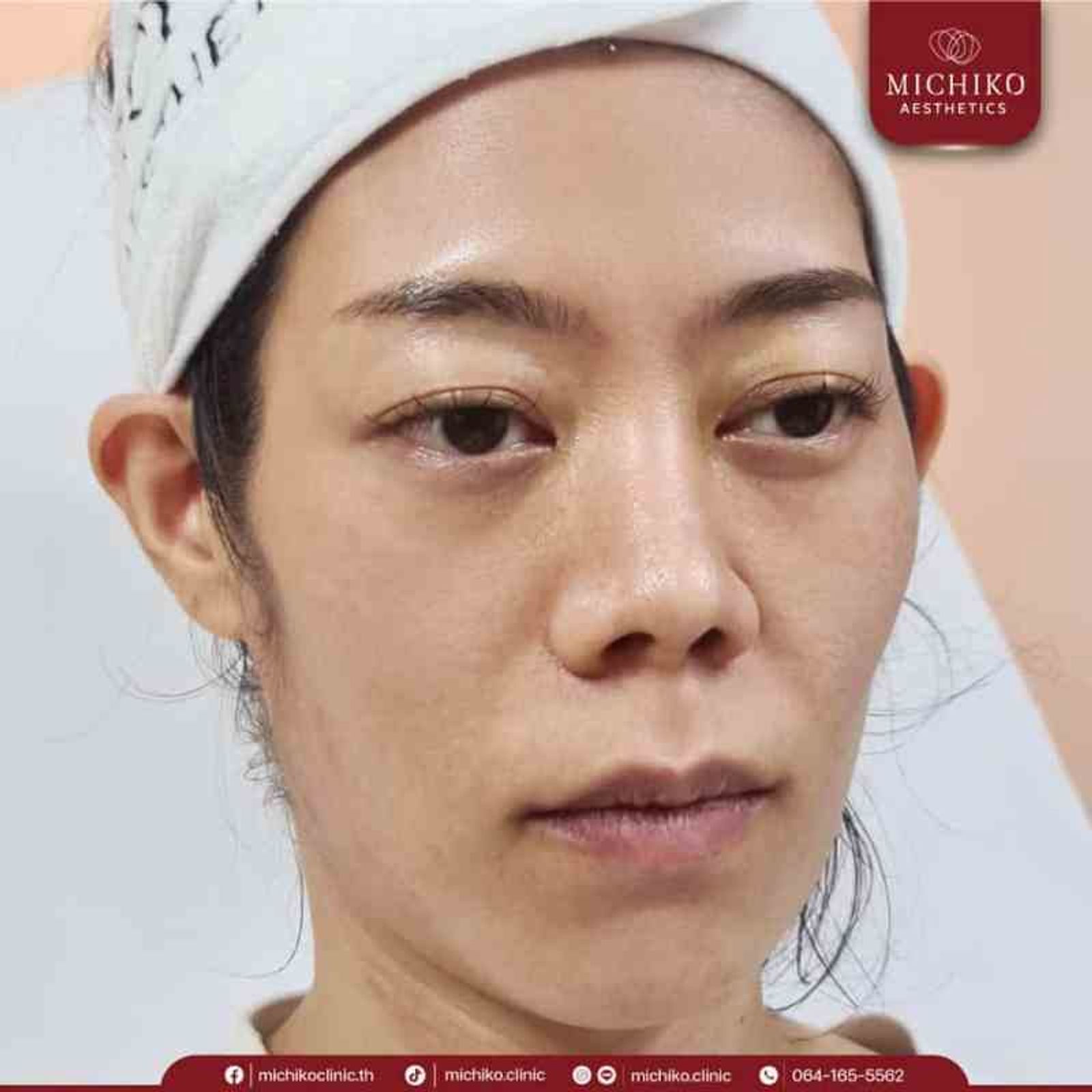 [รีวิว] หน้าตอบ ใต้ตาลึก ดูโทรม ฉีดฟิลเลอร์ใต้ตาที่มิชิโกะคลินิก ทำให้มั่นใจขึ้นเป็นกอง — ภาพประกอบ 01