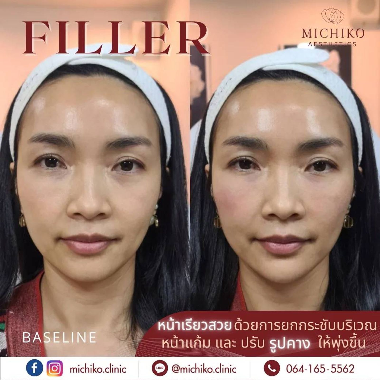 [รีวิว]เคล็ดลับหน้าเด็ก เทคนิคคุณหมอกิ๊ฟ ที่ใครๆ ก็ต้องยอมย้ายคุณหมอมาหาคุณหมอกิ๊ฟแทน!