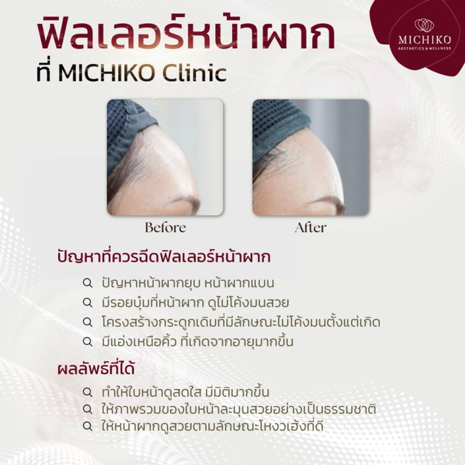 ใครที่กำลังอยากฉีดฟิลเลอร์หน้าผาก ต้องอ่านโพสนี้ก่อน ! — ภาพประกอบ 01