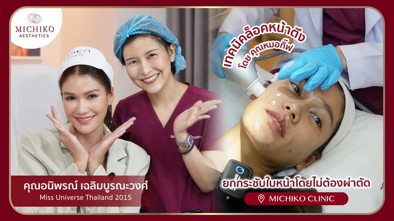 [รีวิว] หน้าเรียวแบบเห็นผลทันที! ด้วยเครื่อง ULTRAFORMER III โดย คุณหมอกิ๊ฟ
