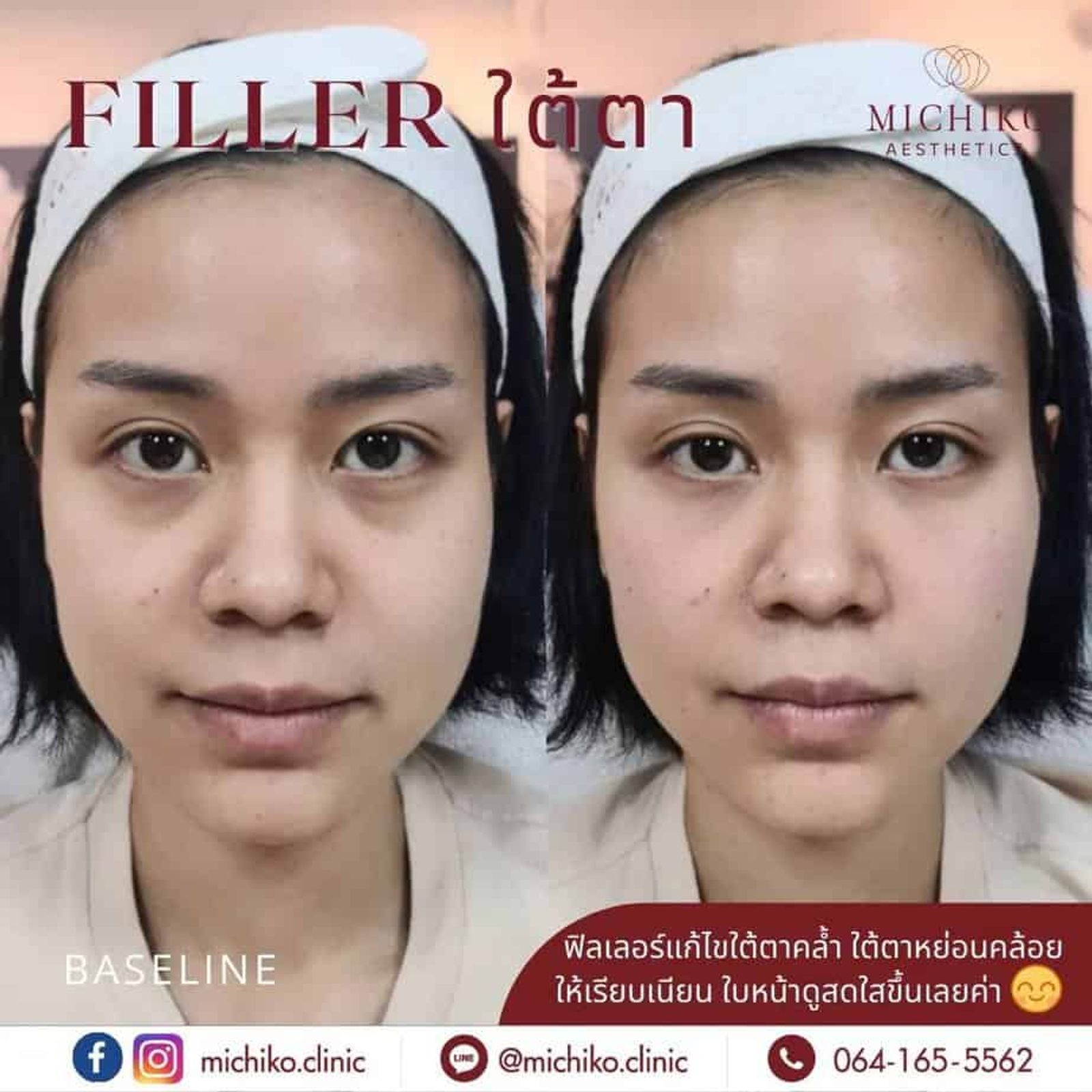 [รีวิว] #ฟิลเลอร์ใต้ตา ที่เน้นการ #แก้ปัญหาจากชั้นโครงสร้าง