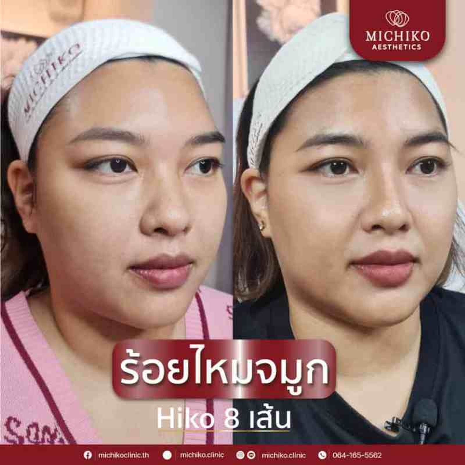 ร้อยไหมจมูกเหมาะกับใครบ้าง !!?? — ภาพประกอบ 03