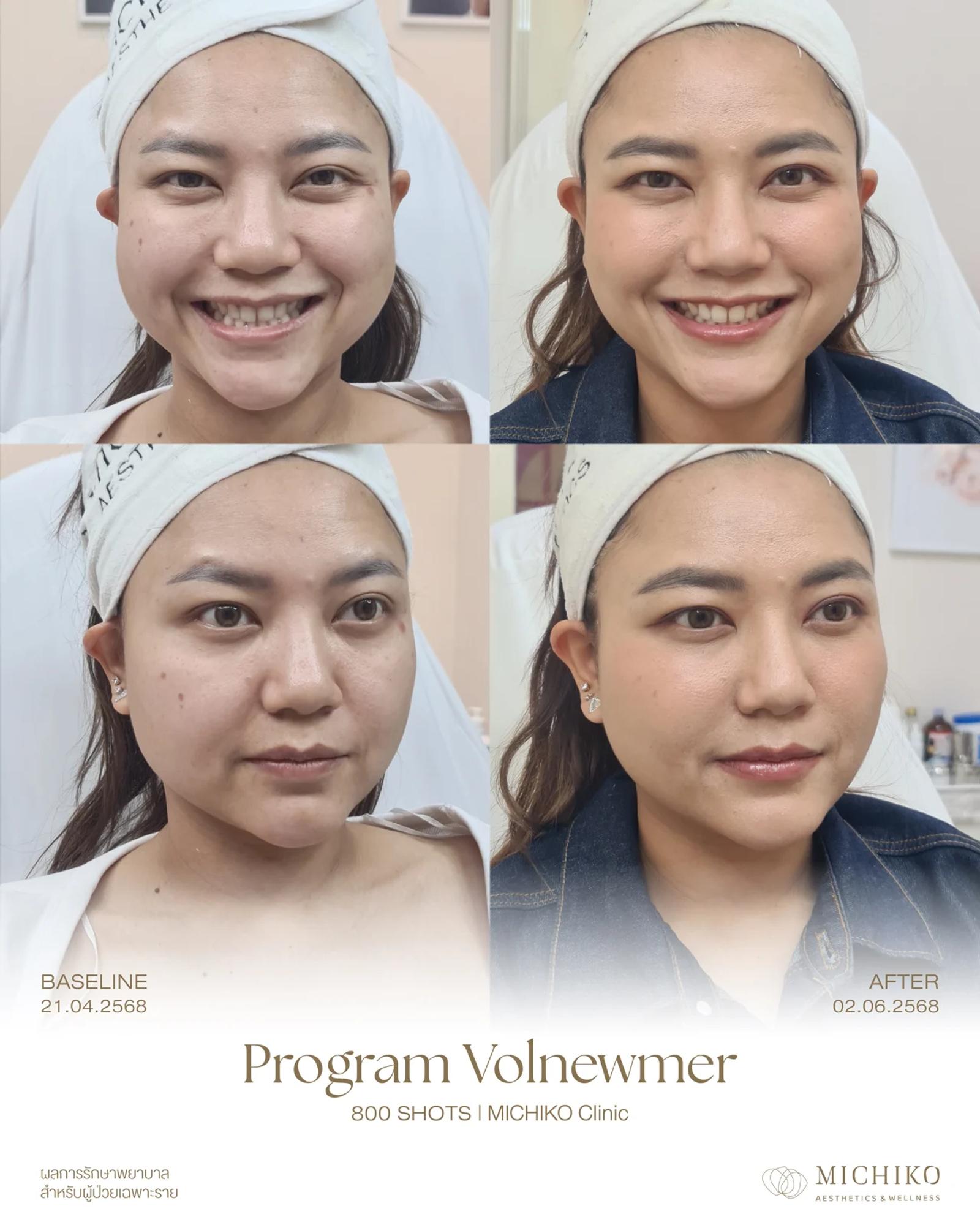 MICHIKO Volnewmer case