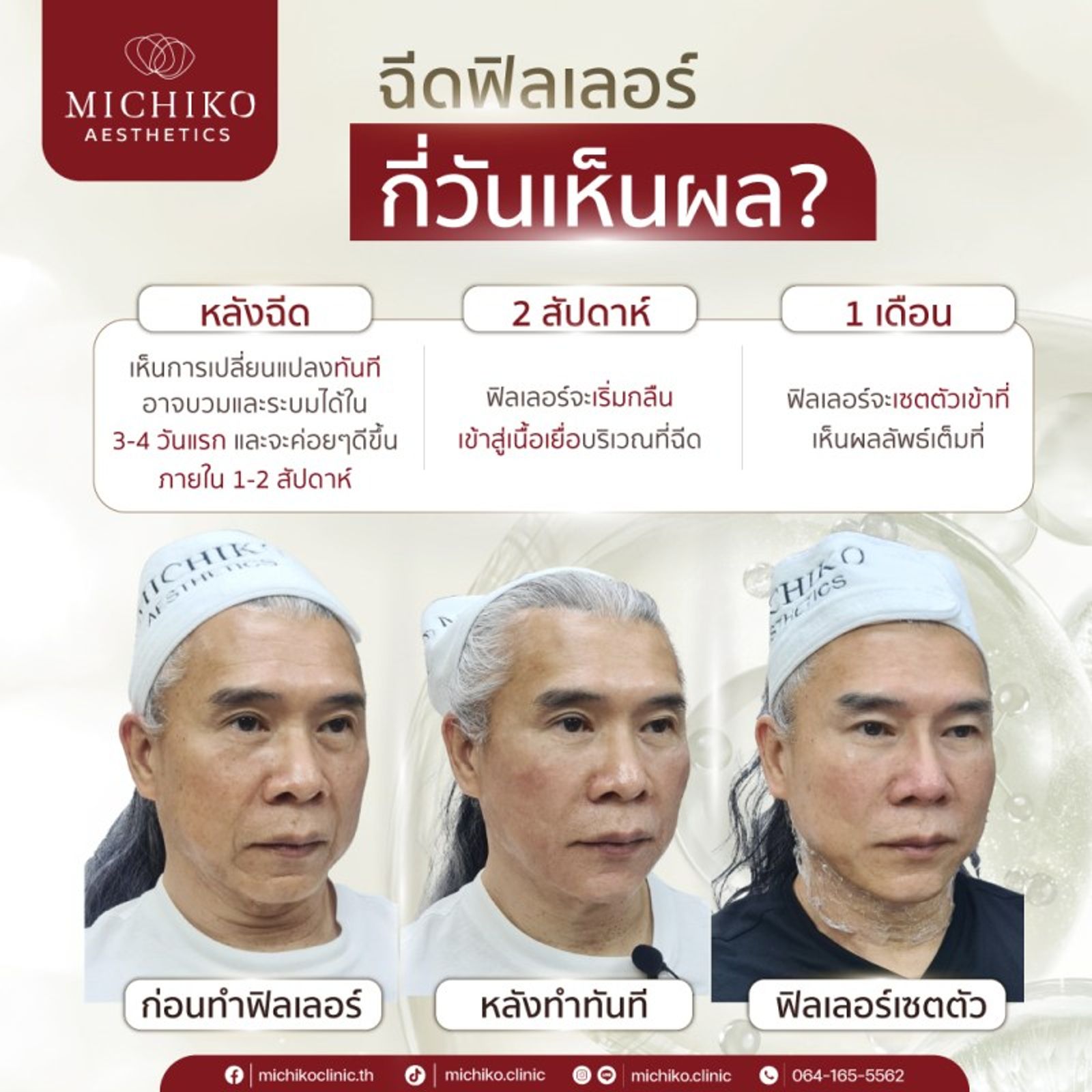 ฟิลเลอร์ กี่วันเห็นผล