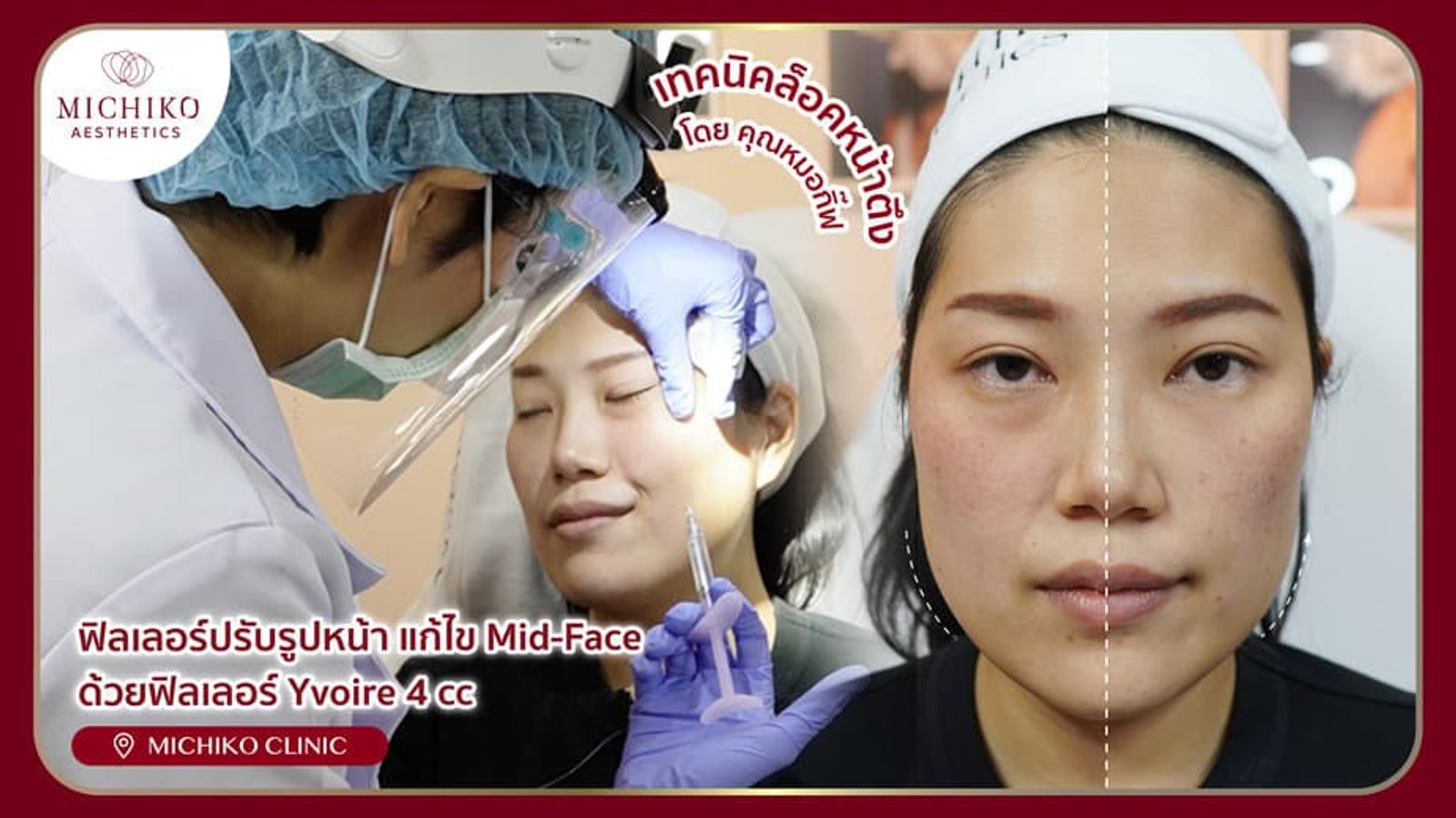 [รีวิว] ฟิลเลอร์หน้าเด็กมีอยู่จริง ด้วยการทำ MIDFACE + โบท็อกกราม