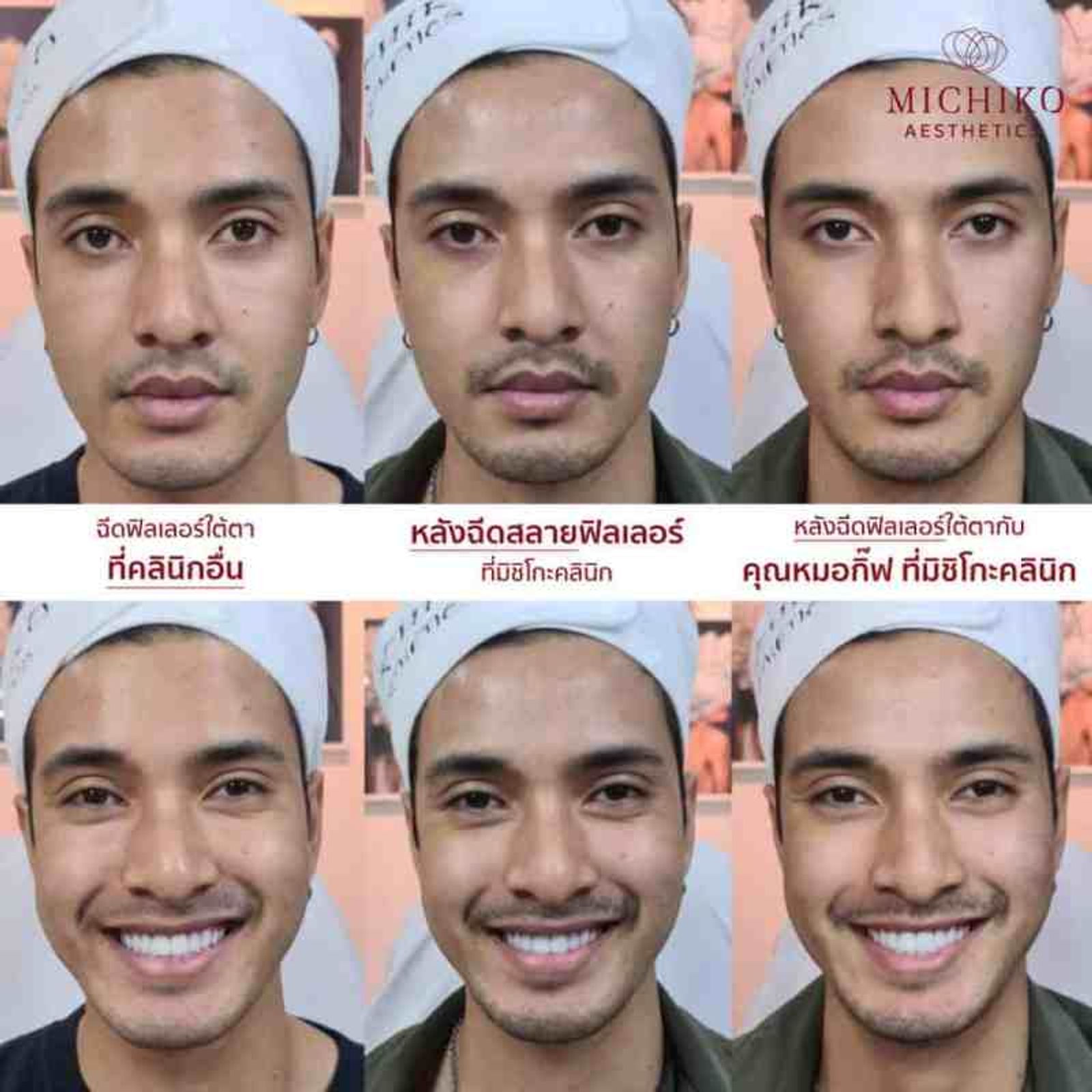 แก้ไขฟิลเลอร์ใต้ตา
