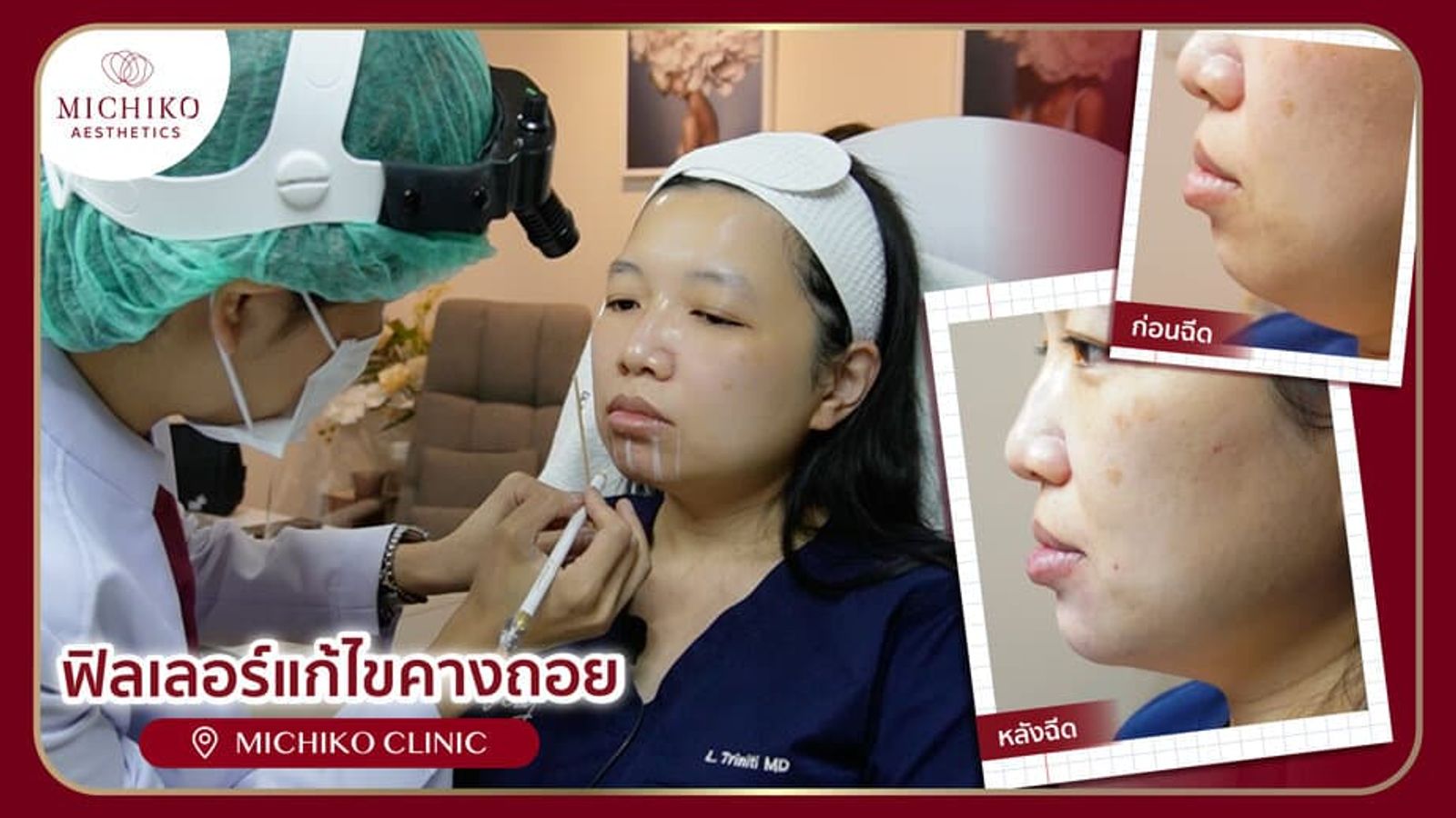 [รีวิว] ฉีดฟิลเลอร์ครั้งแรก!! แก้ไขโครงสร้างคางและขากรรไกรแบบไม่ต้องผ่าตัด โดย คุณหมอกิ๊ฟ