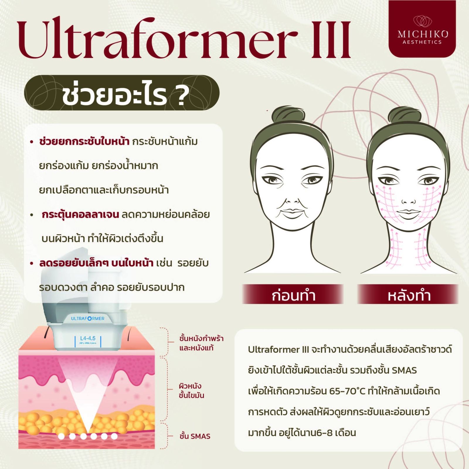 หน้ายกกระชับ แบบสับๆ ไม่ต้องพึ่งเข็ม ไม่ต้องผ่าตัด ด้วย Ultraformer III
