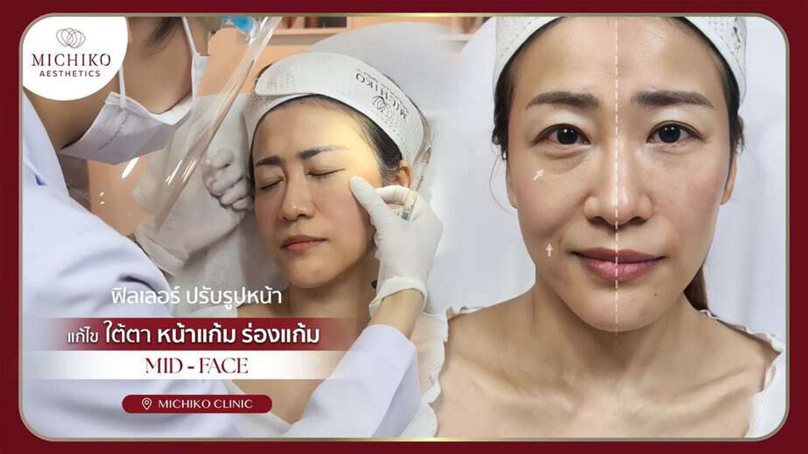 [รีวิว] ฟิลเลอร์ปรับรูปหน้า หน้ามีมิติ ร่องแก้มตื้นขึ้น โดยคุณหมอกิ๊ฟ