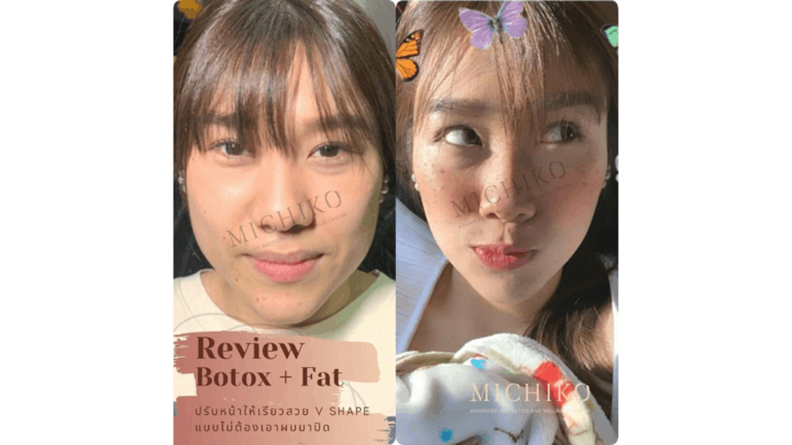 รีวิว botox