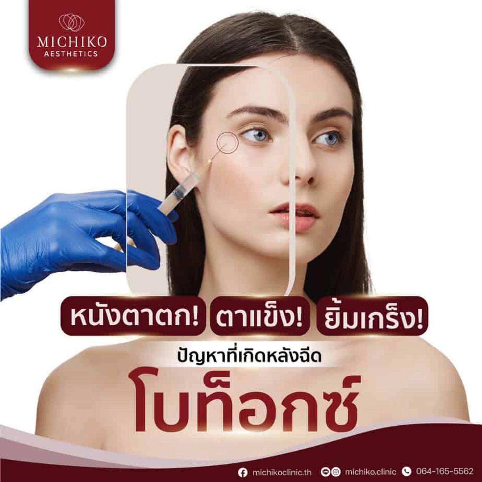 หนังตาตก ! ตาแข็ง ! ยิ้มเกร็ง ! ปัญหาที่เกิดหลังฉีดโบท็อก