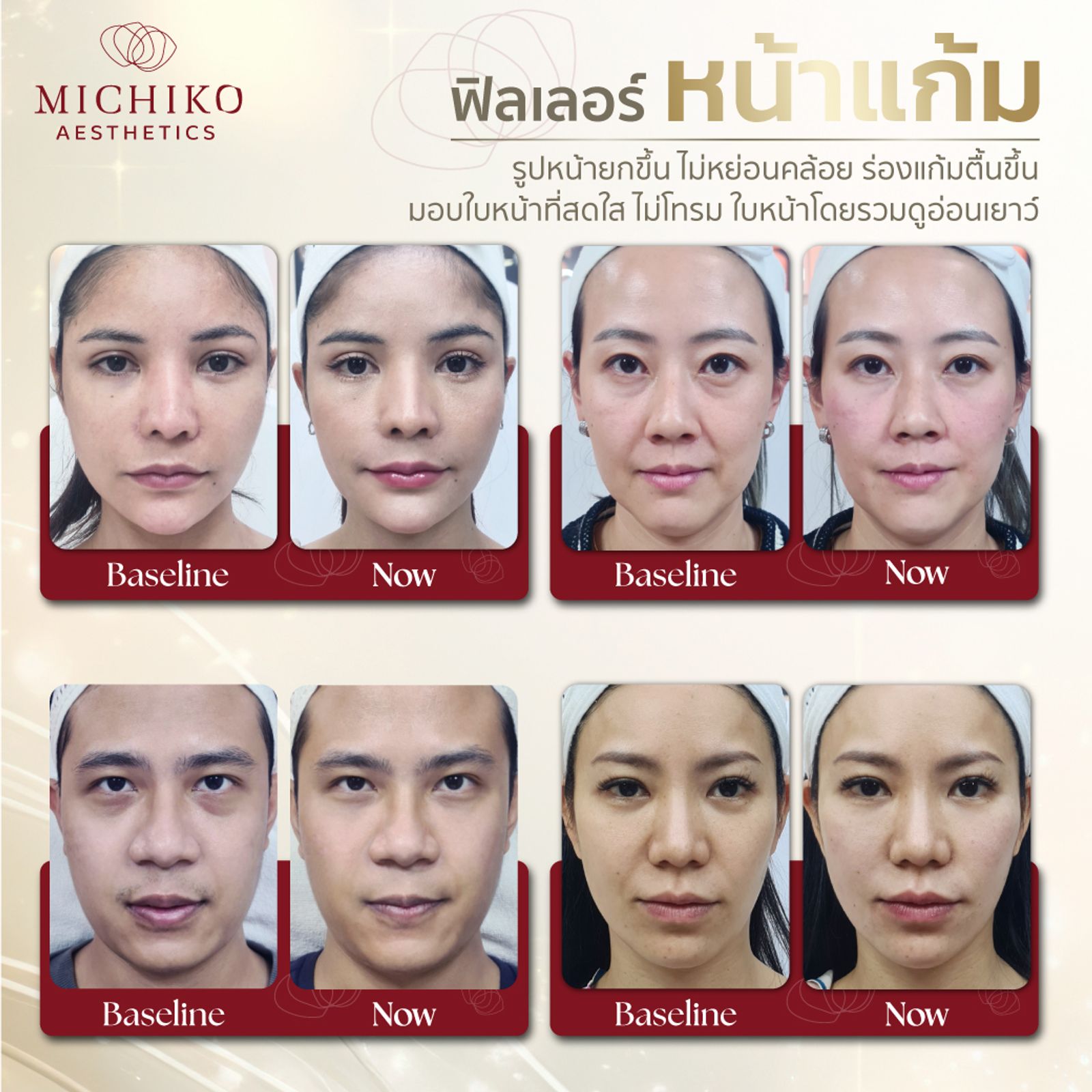 จุดฉีดฟิลเลอร์แล้วสวยแน่นอน !!!