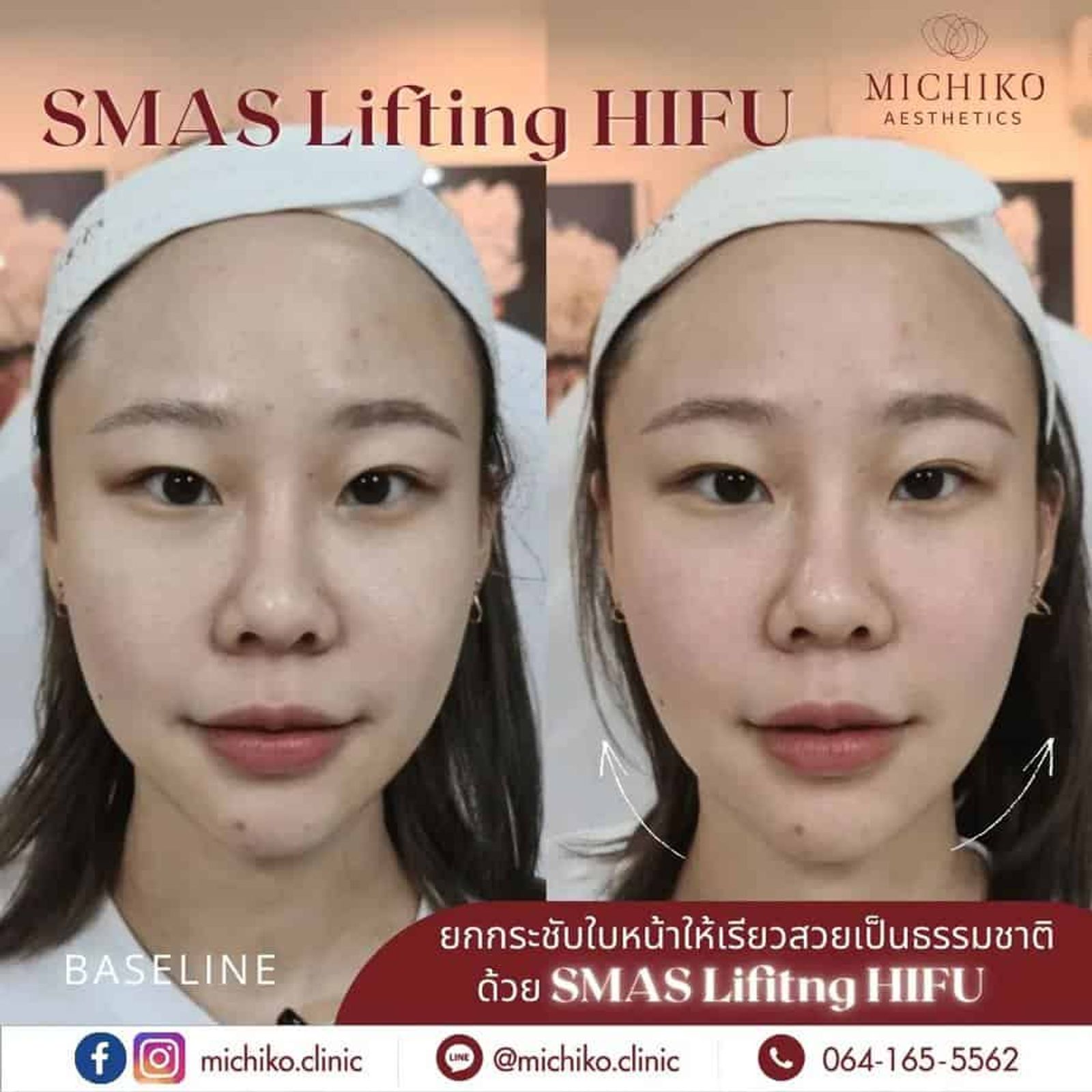 [รีวิว] HIFU มาหลายที่ แต่ประทับใจที่ #MichikoClinic มากกกๆ