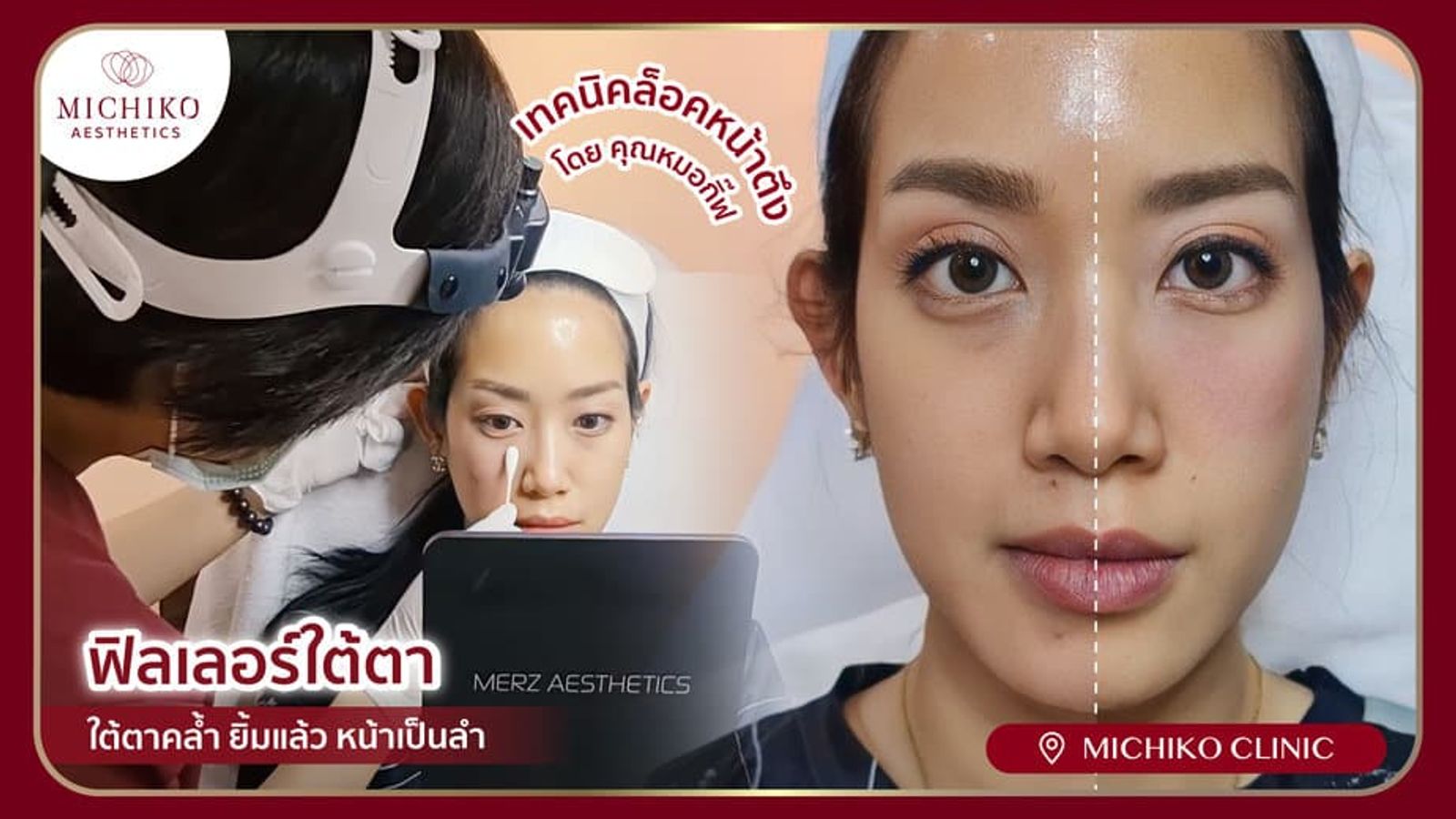 [รีวิว] ฟิลเลอร์แก้ใต้ตาดำคล้ำ ยิ้มแล้วเป็นลำ ด้วยเทคนิคฉีดฟิลเลอร์ขั้นสูง